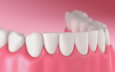 Truths and Misconceptions About Dentures in Kona